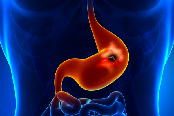 Pet Mein Ulcer