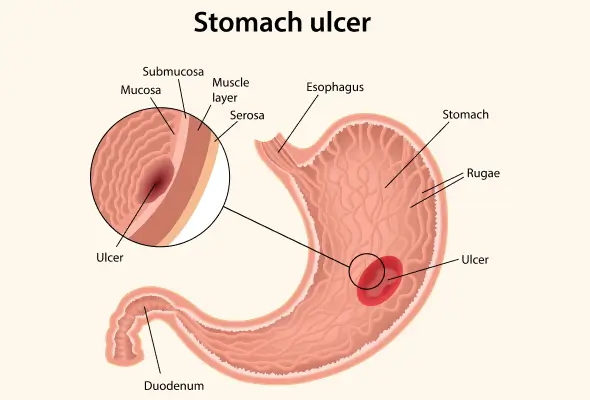 Pet Mein Ulcer