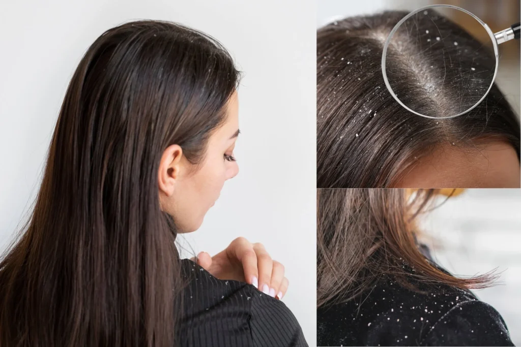 Monsoon Mein Dandruff
