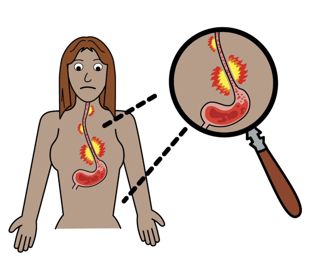 Acid Reflux Symptoms