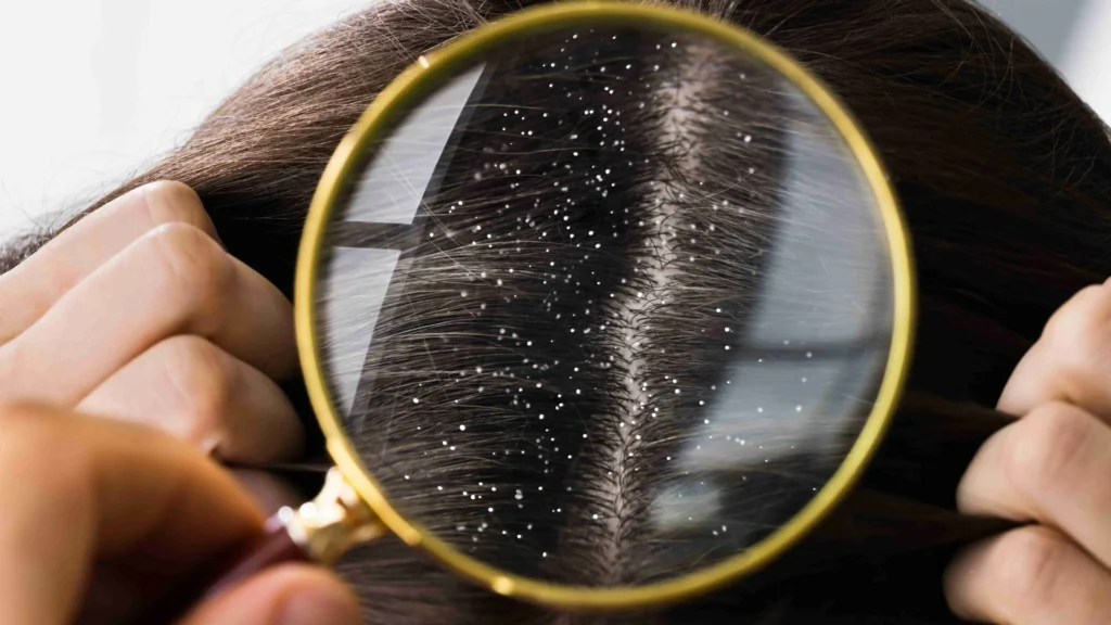 Monsoon Mein Dandruff