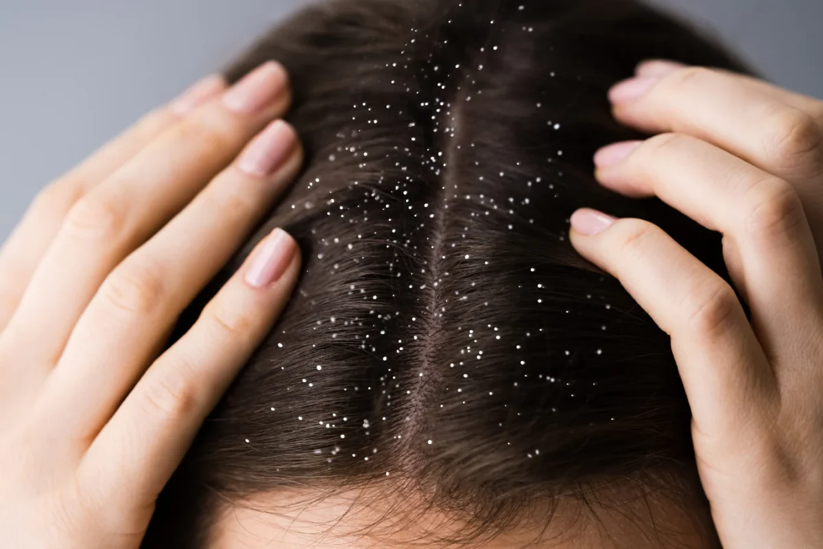 Monsoon Mein Dandruff